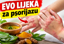 MUČI VAS PSORIJAZA? Ovi prirodni lijekovi mogu pomoći da smirite crvenilo, svrbež i perutanje kože
