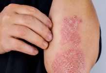 Nikad Više Nećete Baciti Koru 0d Ove Voćke: LiječI Psorijazu, Skida Bradavice I Izbjeljuje Zube