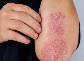 Nikad Više Nećete Baciti Koru 0d Ove Voćke: LiječI Psorijazu, Skida Bradavice I Izbjeljuje Zube